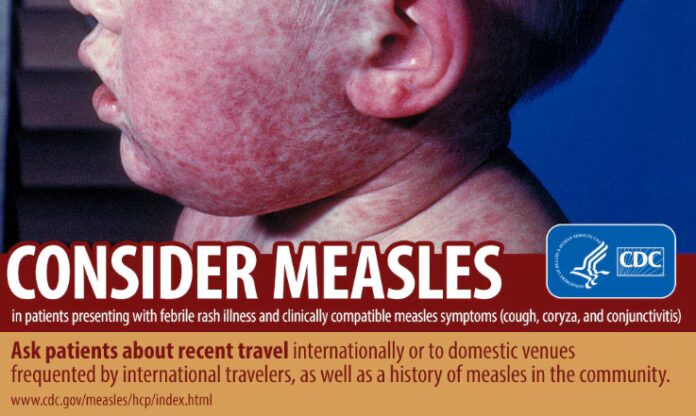 consider-measles-infographic (1) Available at: https://www.cdc.gov/measles/images/filter-sort/consider-measles-infographic.jpg (Accessed: 14 March 2025).